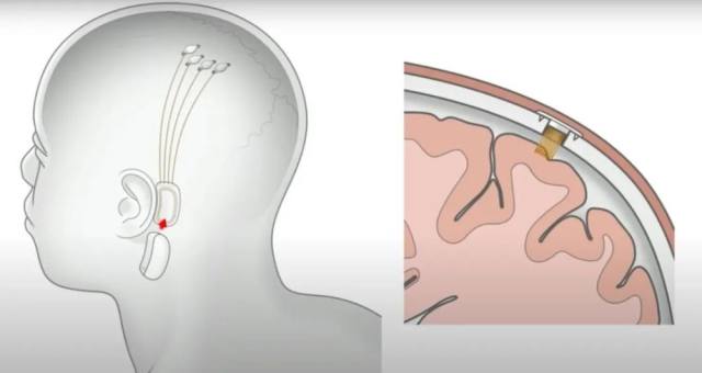 脑机接口公司Neuralink研发到何种程度了？插图(7)